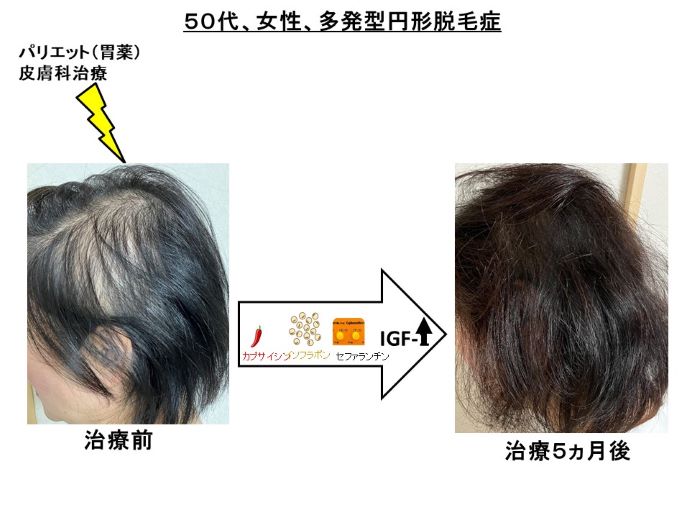 円形脱毛症　病院